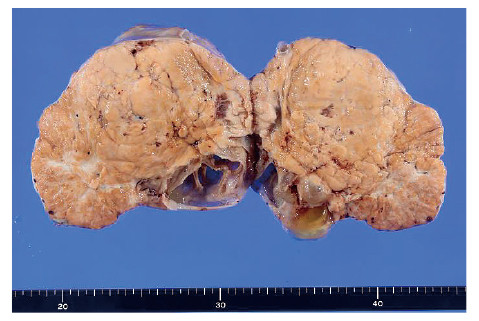 Macroscopic view of a right ovary showing ovarian strumal carcinoid tumor, with a scale for reference.