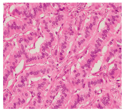Microscopic view of ovarian strumal carcinoid tissue, showing a cord-like structure with pink and purple staining.