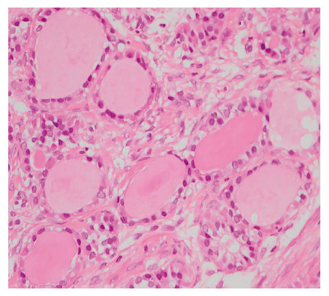 Histological image of ovarian strumal carcinoid showing colloids, stained with hematoxylin and eosin at 400x magnification.