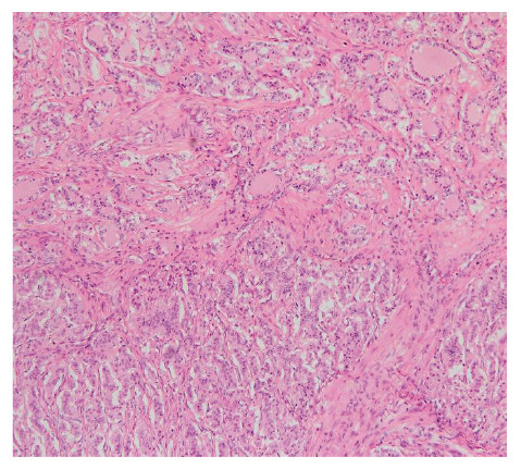 Histological image showing mixed structures of colloids and cord-like lesions in ovarian strumal carcinoid, stained with HE.