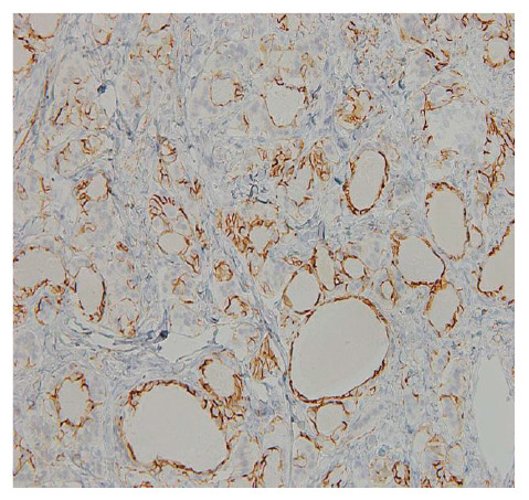 Microscopic view of ovarian strumal carcinoid tissue stained with CD56, showing distinct cellular structures.
