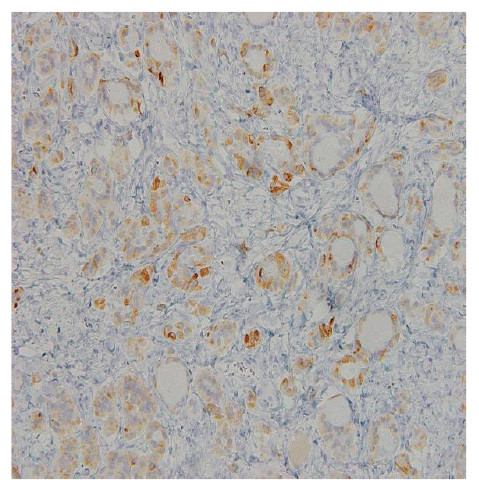 Colloid stained tissue sample showing TTF-1 expression in ovarian strumal carcinoid at 200x magnification.