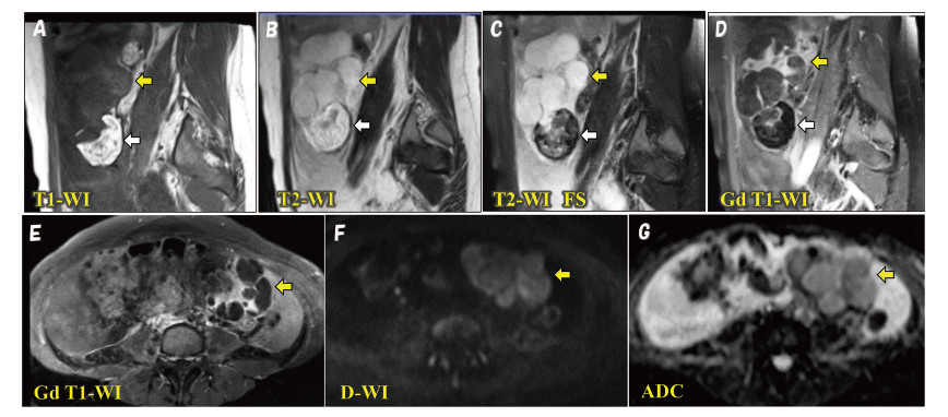 Medical imaging series showing various MRI sequences with highlighted areas of interest.