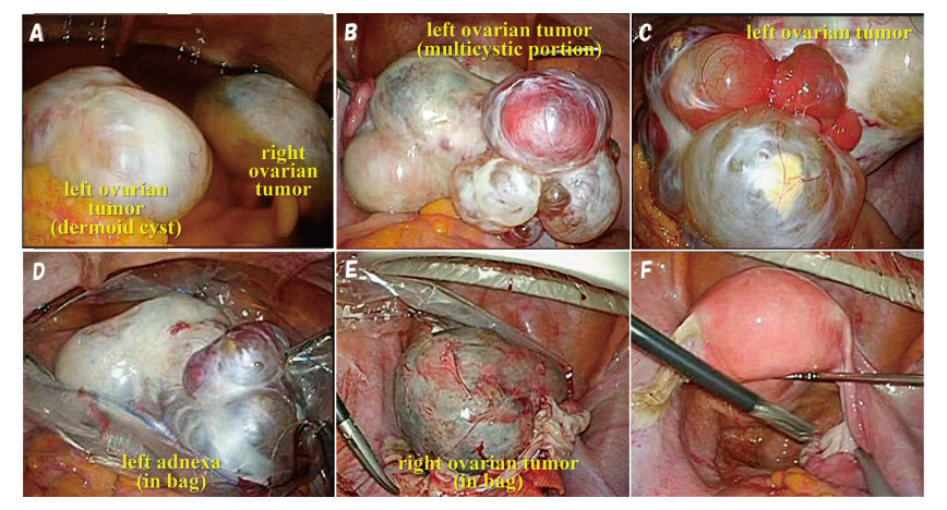 Medical images showing various types of ovarian tumors during a surgical procedure, including dermoid and multiloculated cysts.