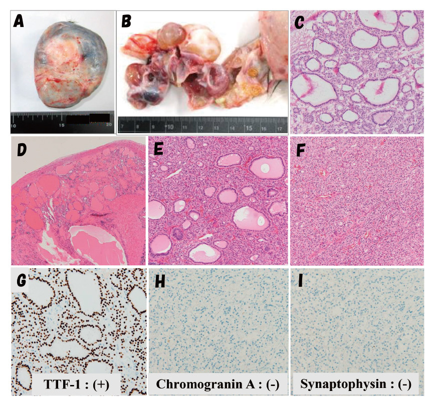 Histopathological images showing a dermoid cyst and multicystic tumor in the ovaries, with findings of struma ovarii.