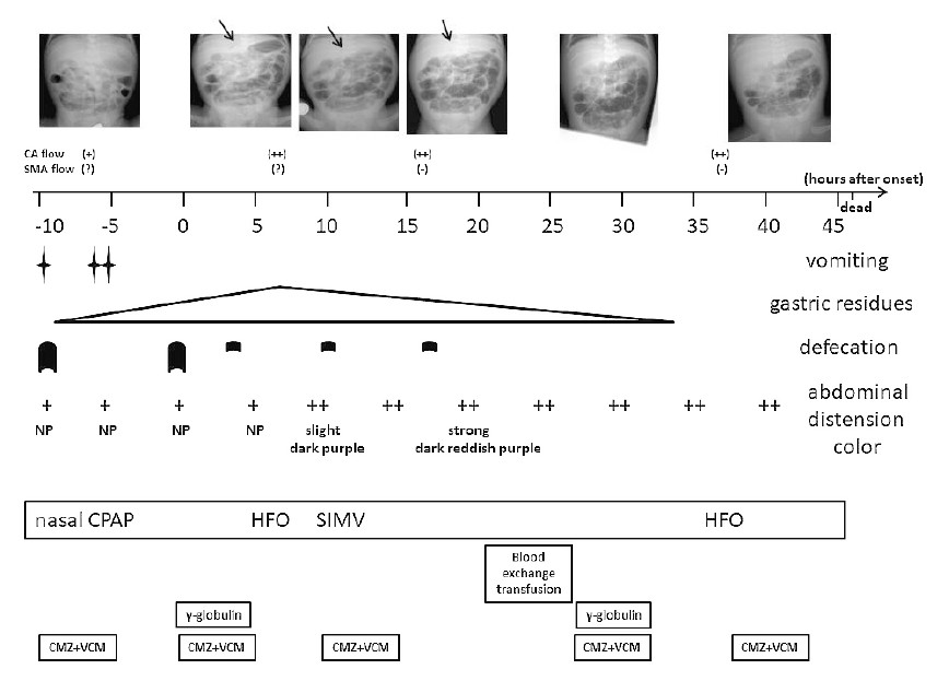 ALT: Clinical timeline and abdominal radiograph showing progression of symptoms in a preterm infant with necrotizing enterocolitis.