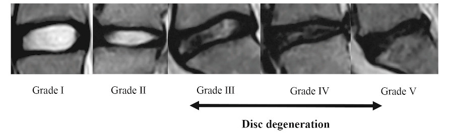 MRI images showing different grades of disc degeneration from Grade I to Grade V.