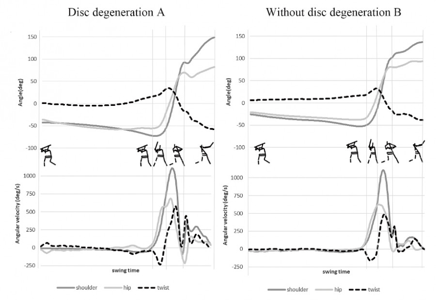 Graph comparing shoulder, hip, and twist rotation angles during baseball batting for players with and without lumbar disc degeneration.