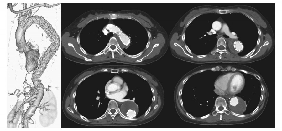Medical imaging showing a detailed view of the thoracic aorta and surrounding structures.