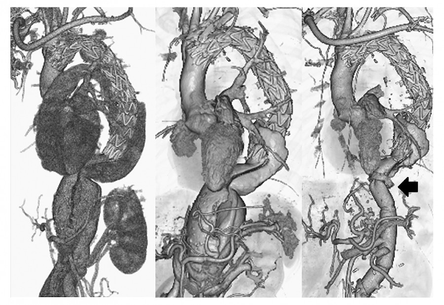 Contrast-enhanced CT images showing a staged hybrid repair for chronic type B aortic dissection, highlighting changes over time.