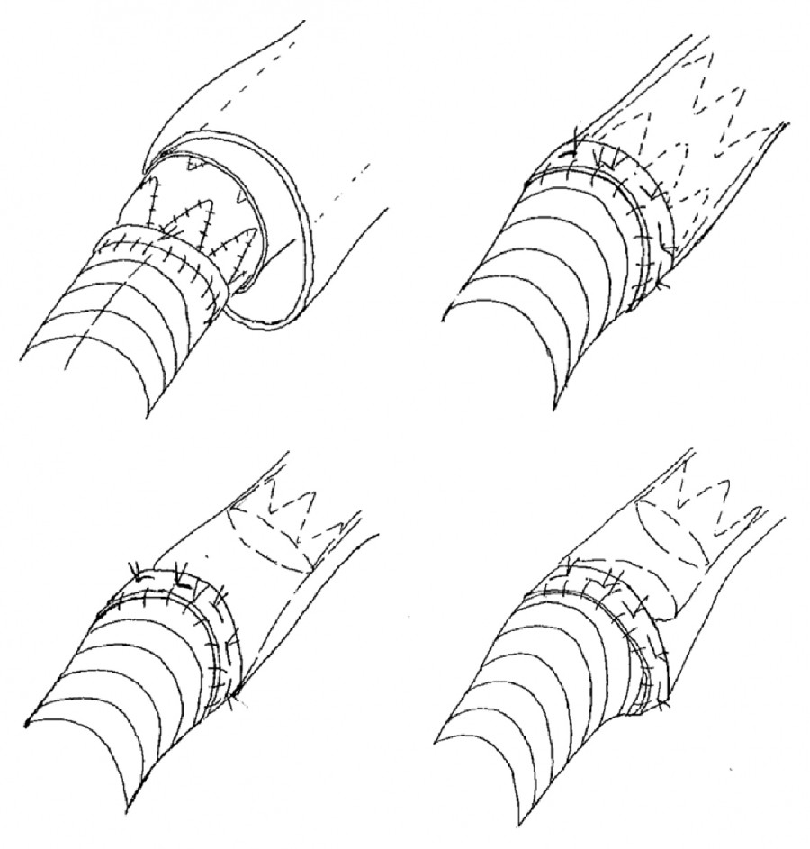 Schematic representation of hybrid repair techniques for chronic type B aortic dissection, showing various anastomosis methods.