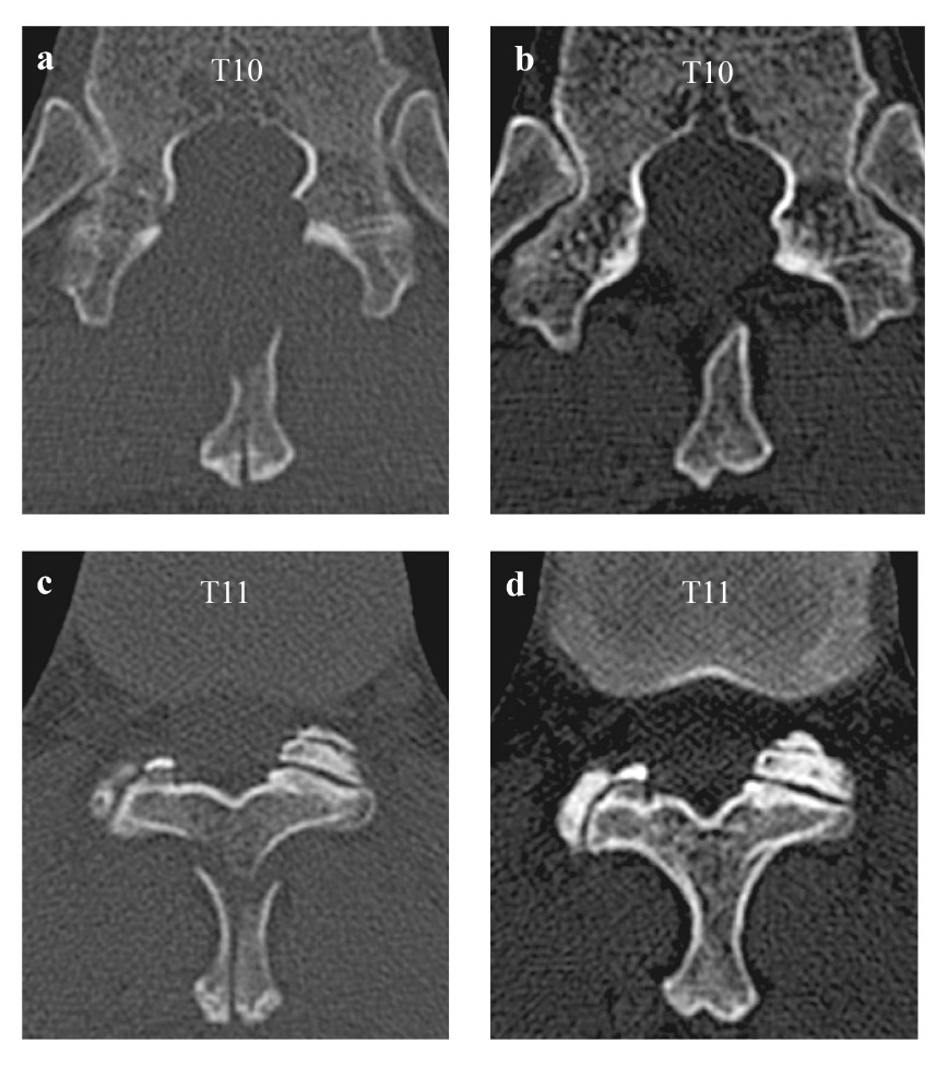 CT images of thoracic vertebrae T10 and T11, showing detailed bone structures and anatomical features.
