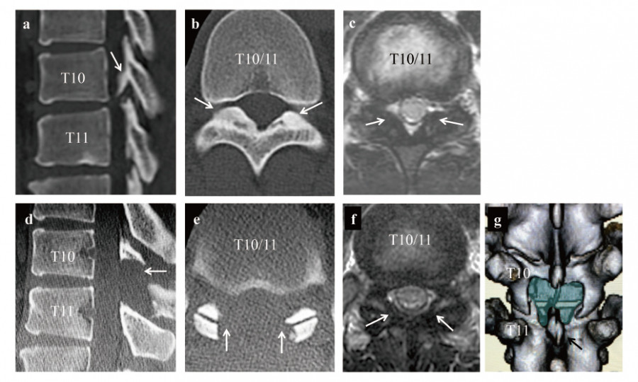 Medical imaging showing various views of the thoracic spine, highlighting vertebrae T10 and T11.