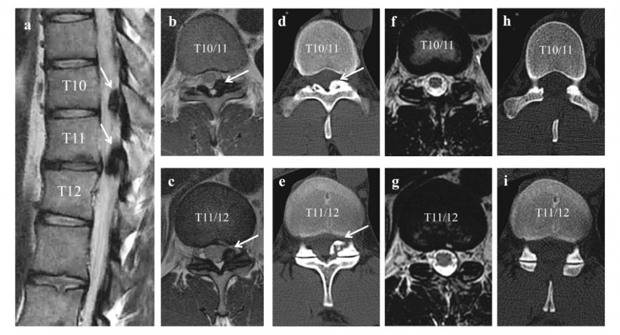 Pre- and postoperative MRI and CT images showing ossification of the ligamentum flavum at T10/11 and T11/12 in a thoracic spine case.