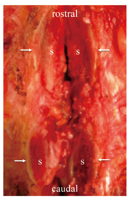 Intraoperative view of split spinous processes in the thoracic spine, showing muscle preservation.