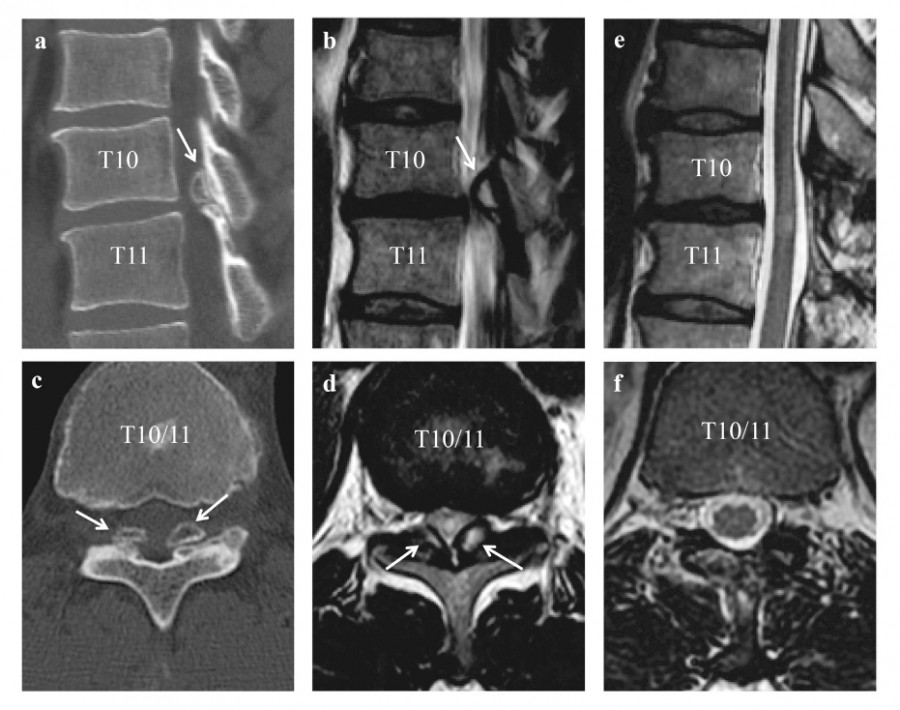 Pre- and postoperative CT and MRI images showing ossification of the ligamentum flavum at T10/11 in a professional athlete.
