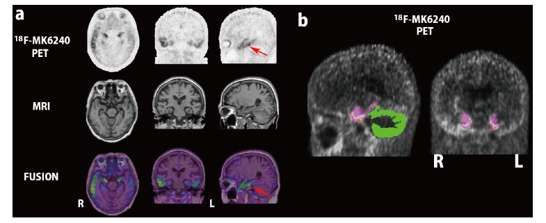 Medical imaging comparison showing 18F-MK6240 PET, MRI, and fusion images highlighting brain regions.