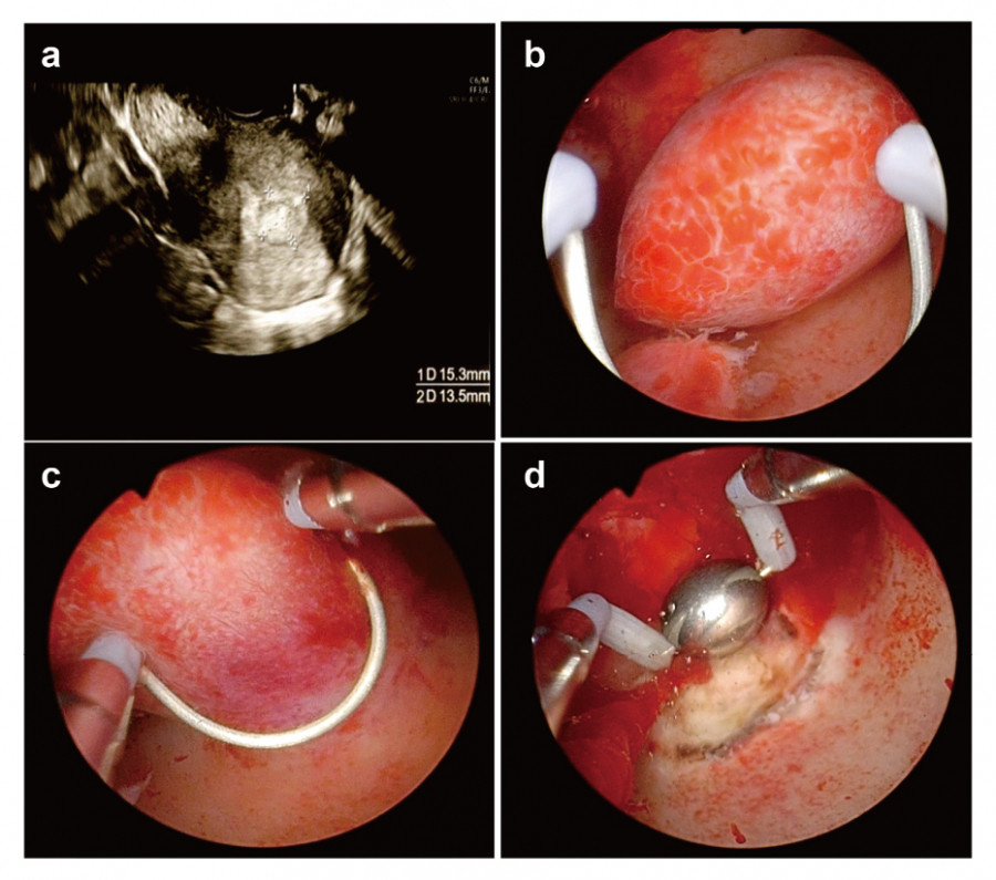 Transvaginal ultrasound showing a hyperechoic uterine lesion, followed by images of endometrial polyp resection and hemostasis.