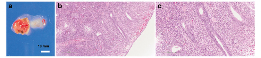 Macroscopic view of a resected endometrial polyp specimen, with scale bar indicating 10 mm.