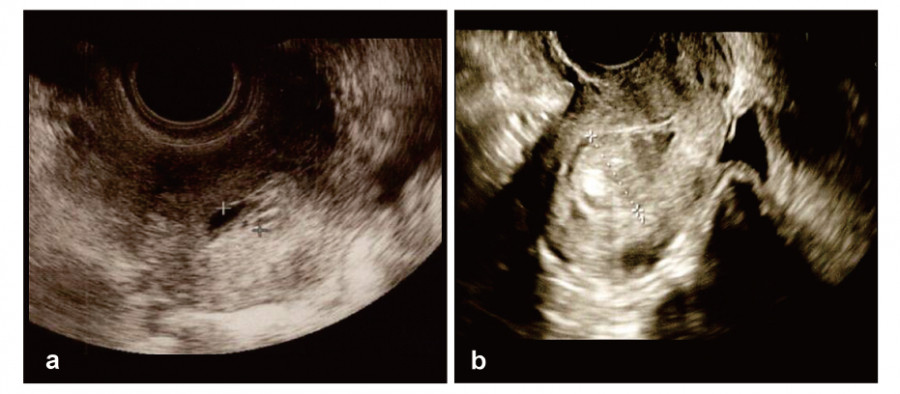 Ultrasound images showing two different views of internal structures, highlighting medical diagnostics.