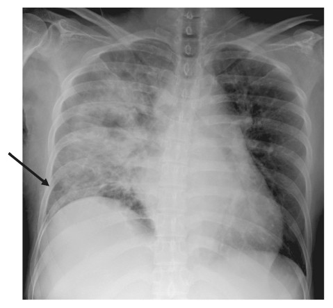 Chest radiography showing infiltrating and frosted shadows indicative of maternal septic shock.
