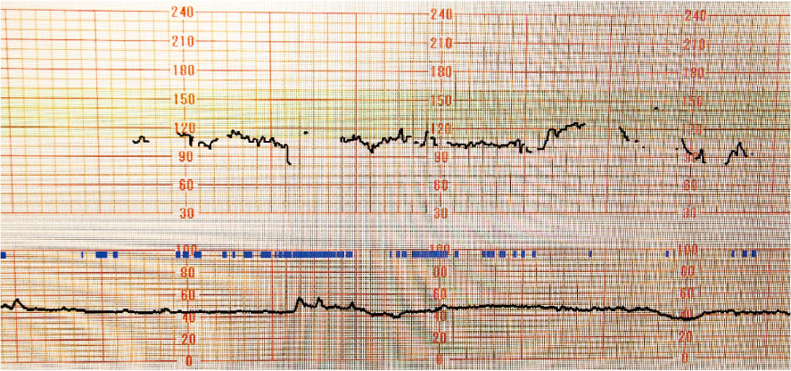 Fetal cardiotocogram (CTG) displaying heart rate and uterine contractions in a clinical setting.