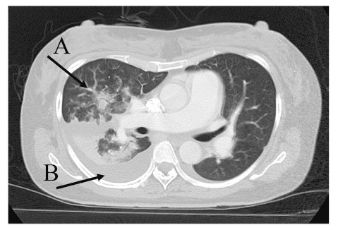 CT scan image showing lung abnormalities with labeled areas A and B.
