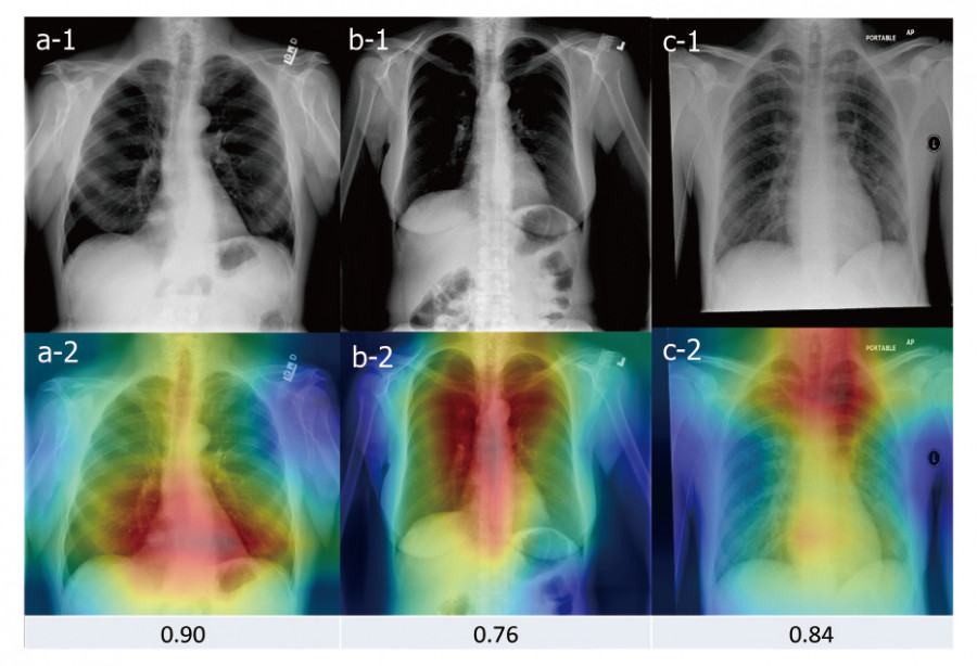 AI algorithm detecting pulmonary nodules in chest X-rays, with highlighted areas and probability scores.