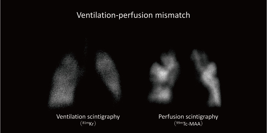 Ventilation-perfusion mismatch illustrated through scintigraphy images, showing distinct patterns for ventilation and perfusion.