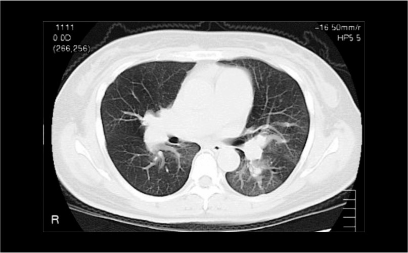 CT scan image of a human chest showing lung structures and airways.