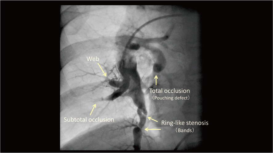 Selective pulmonary angiography image showing various lesion morphologies, including total occlusion and stenosis.