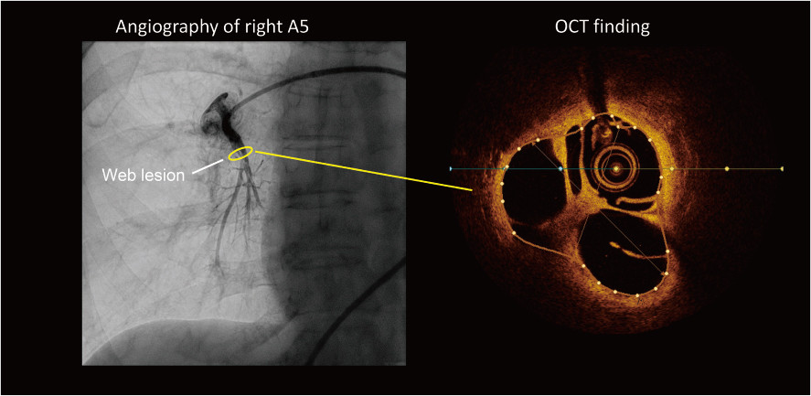 Optical coherence tomography image showing a web lesion in the pulmonary artery alongside angiography of the right A5.