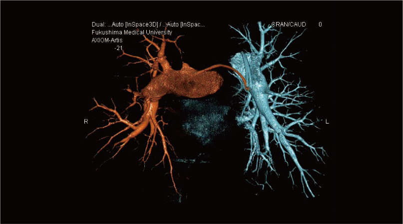 Three-dimensional image of the pulmonary arteries, showing the right artery in red and the left artery in blue.