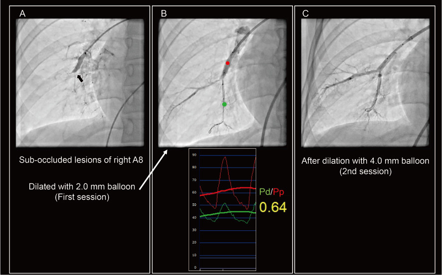 Angiography images showing balloon pulmonary angioplasty for sub-total occluded lesions, with pressure gradient analysis.