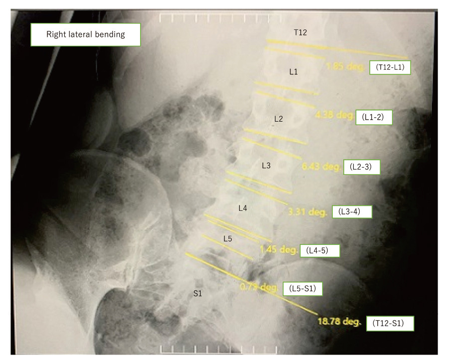 X-ray image showing right lateral flexion of the spine from T12 to S1