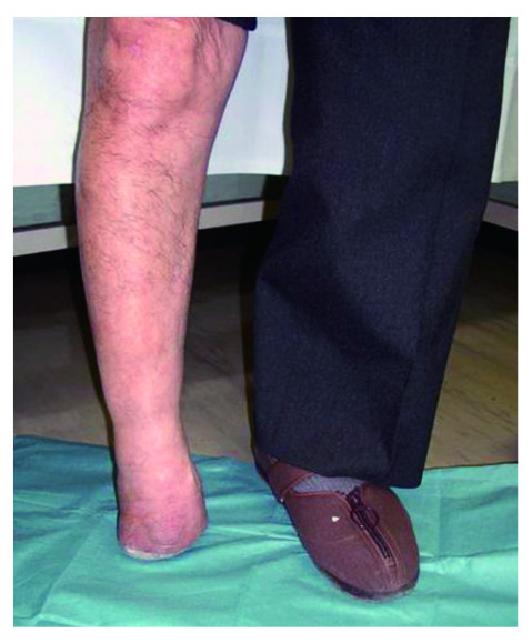 A person standing with one leg amputated at the Chopart joint, demonstrating stability without a prosthesis.