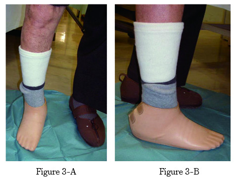 A person standing with a foot prosthesis on the right foot, showing stable posture from both anterior and side views.