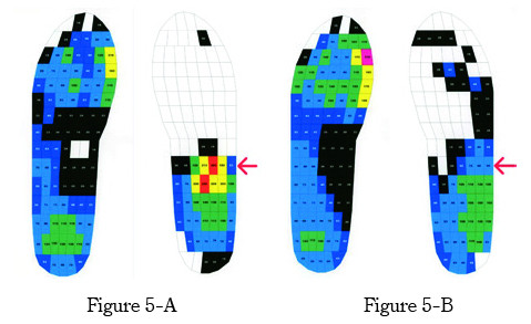 Plantar pressure distribution on feet during walking, comparing Chopart amputated foot without and with prosthesis.