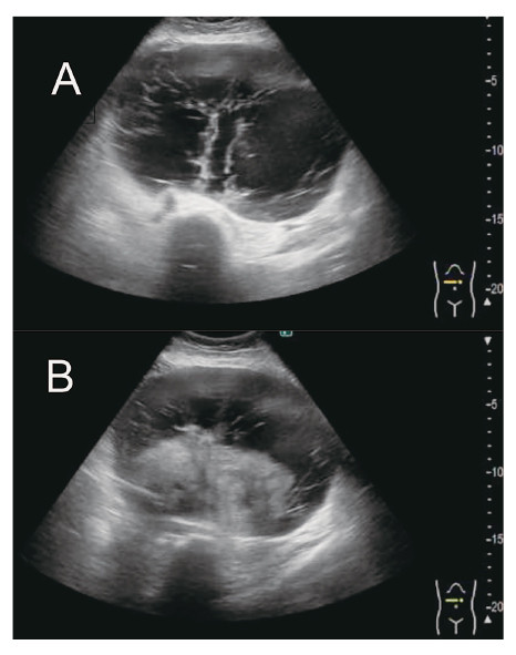Transabdominal ultrasound images showing a large lesion in the lower abdomen, with unclear boundaries of the uterus and cystic regions.