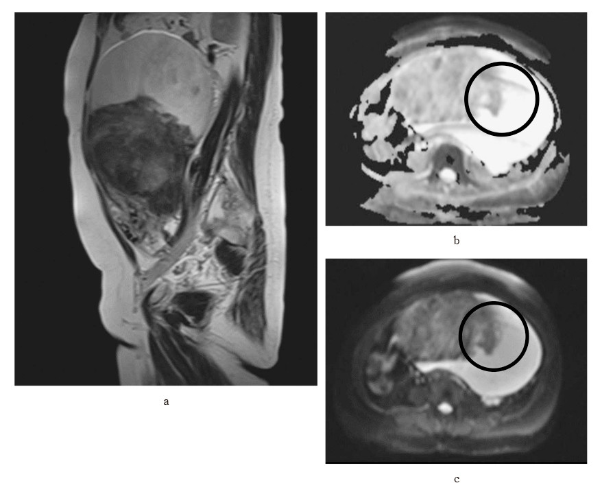 MRI images showing a hydropic leiomyoma-like ovarian tumor with marked areas indicating potential malignancy.