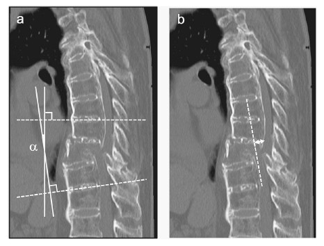 Medical imaging showing spinal alignment with measurement angles labeled in two views.