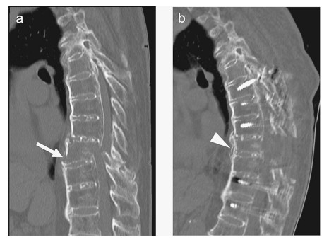 CT scan images showing spinal structures with highlighted areas of interest.