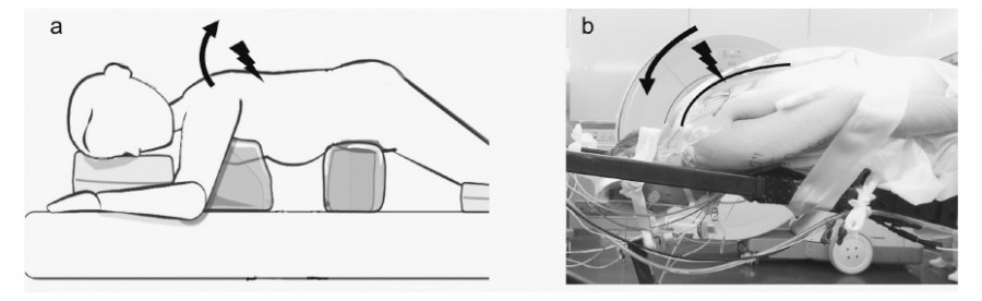 Surgical positioning techniques for thoracolumbar vertebral fractures, illustrating conventional and skull clamp-assisted methods.