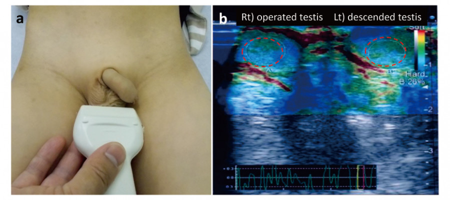 Medical ultrasound examination of a child's groin area, showing operated and descended testis.