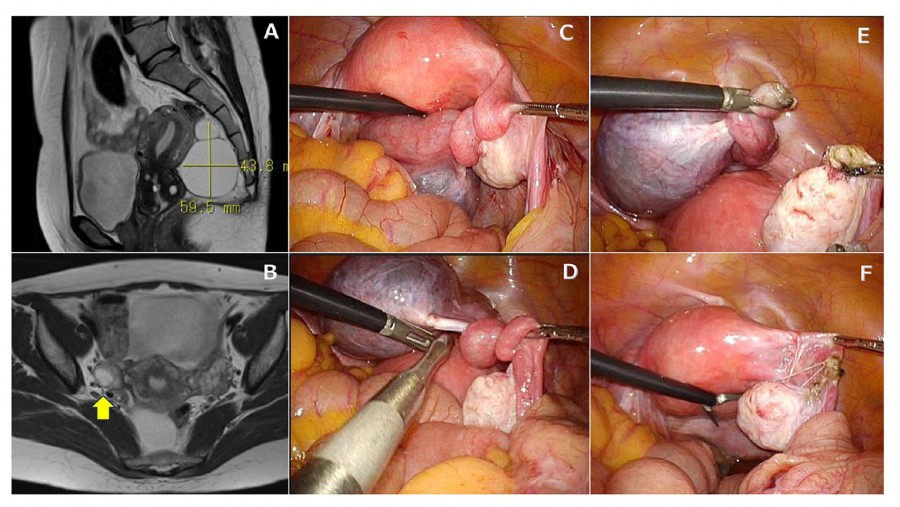 Medical images showing laparoscopic surgery procedures, including various stages of tissue manipulation and examination.