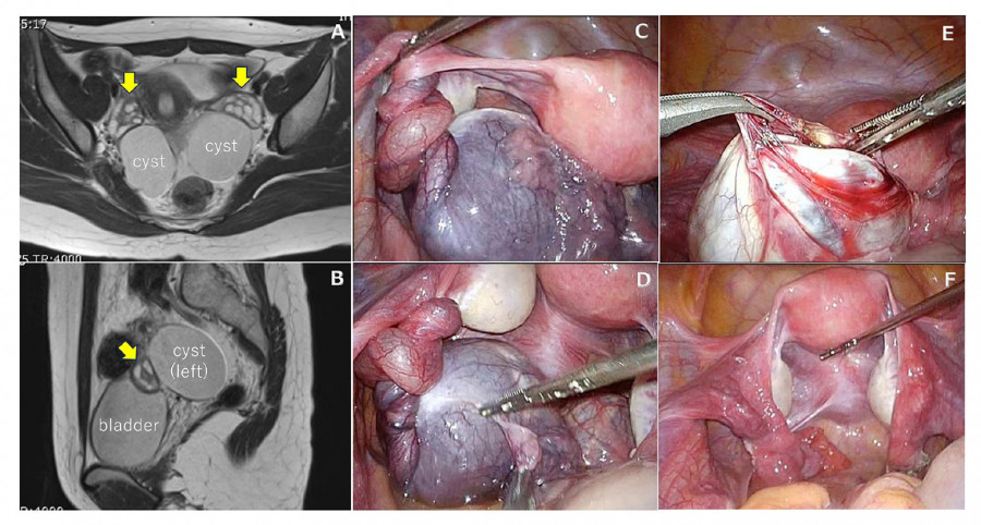 MRI and laparoscopic images showing bilateral cystic tumors and twisted fallopian tube during surgery.