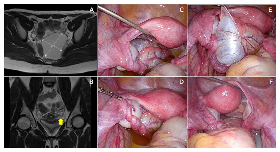 MRI images showing a cystic tumor in the pelvic cavity and laparoscopic findings of twisted fallopian tube.