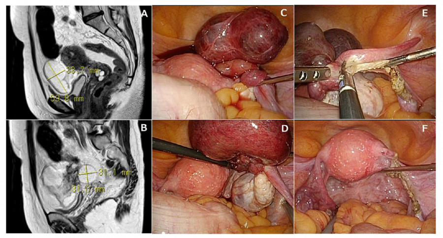 MRI and laparoscopic images showing a cystic tumor and twisted fallopian tube in a pelvic cavity.