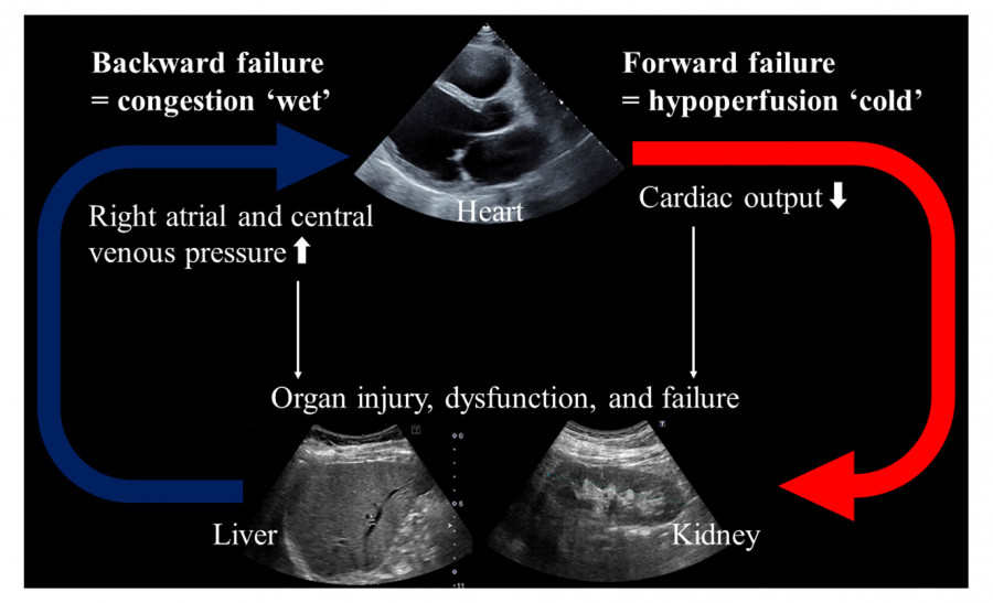 Diagram illustrating hemodynamic features of heart failure, showing heart, liver, and kidney with arrows indicating backward and forward failure.
