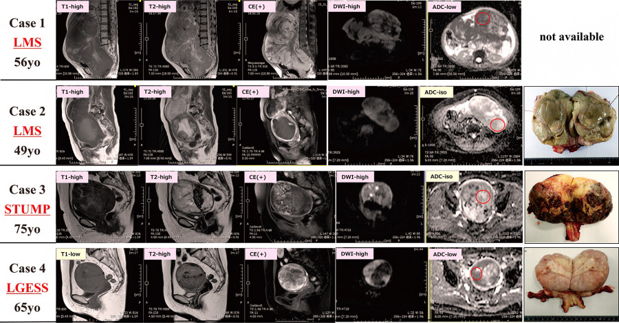 MRI images and pathological specimens of four medical cases, showcasing various tumors and conditions.